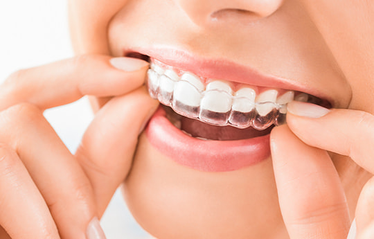 マウスピース矯正