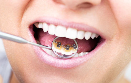 舌側矯正(裏側矯正)